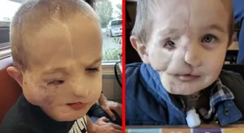 Brave 5-Year-Old Overcomes Dog Attack, Faces Cruel Bullying as a “Monster”